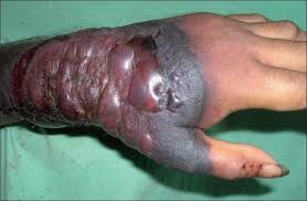 Ebola ravaged hand